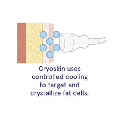 Drawing of layers of human tissue and how Cryoskin affects fat cells within the tissue layers.